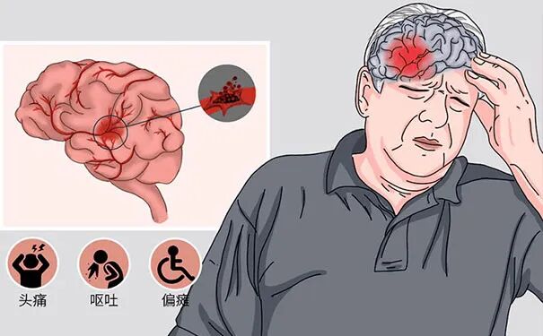 虚拟现实遇上神经电刺激：脑卒中的新时代康复方案